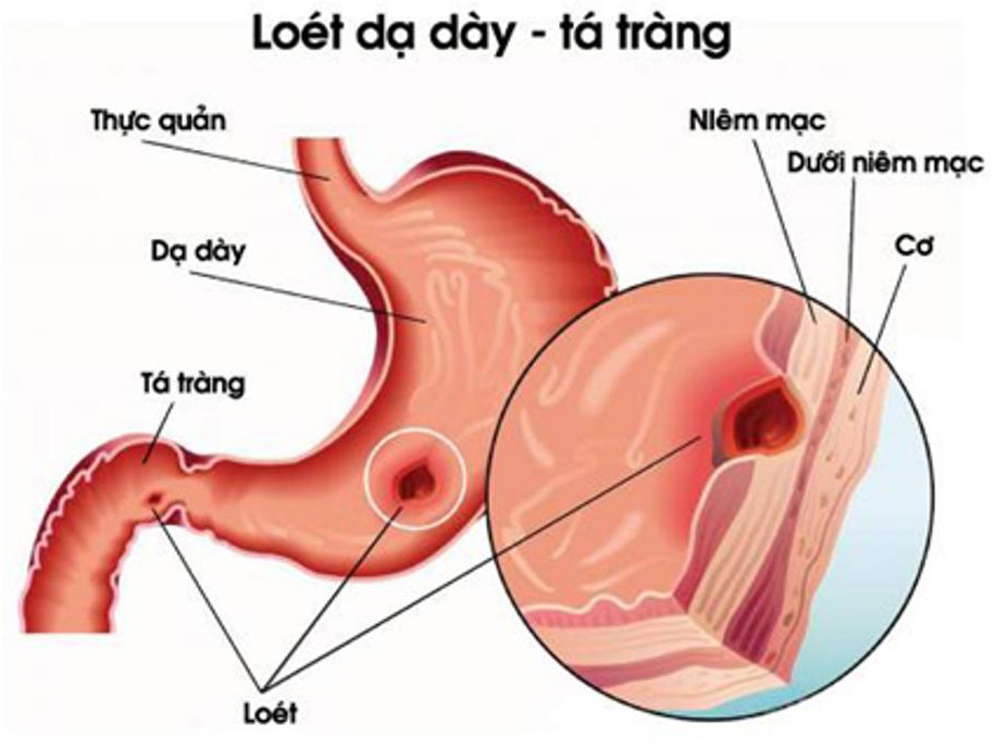 Viêm loét dạ dày tá tràng - Hình ảnh minh họa